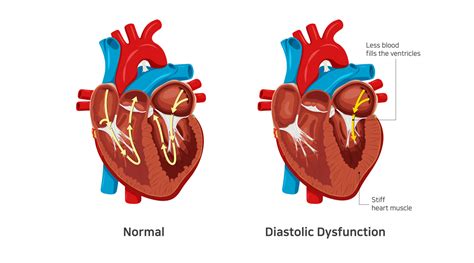 what is Lv diastolic dysfunction